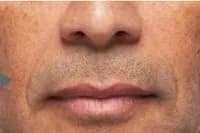 Radiesse for smile lines, male patient, before