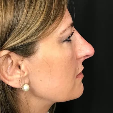 Radiesse, profile view, after