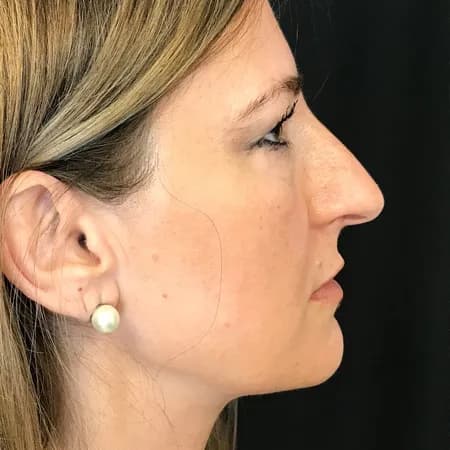 Radiesse, profile view, before