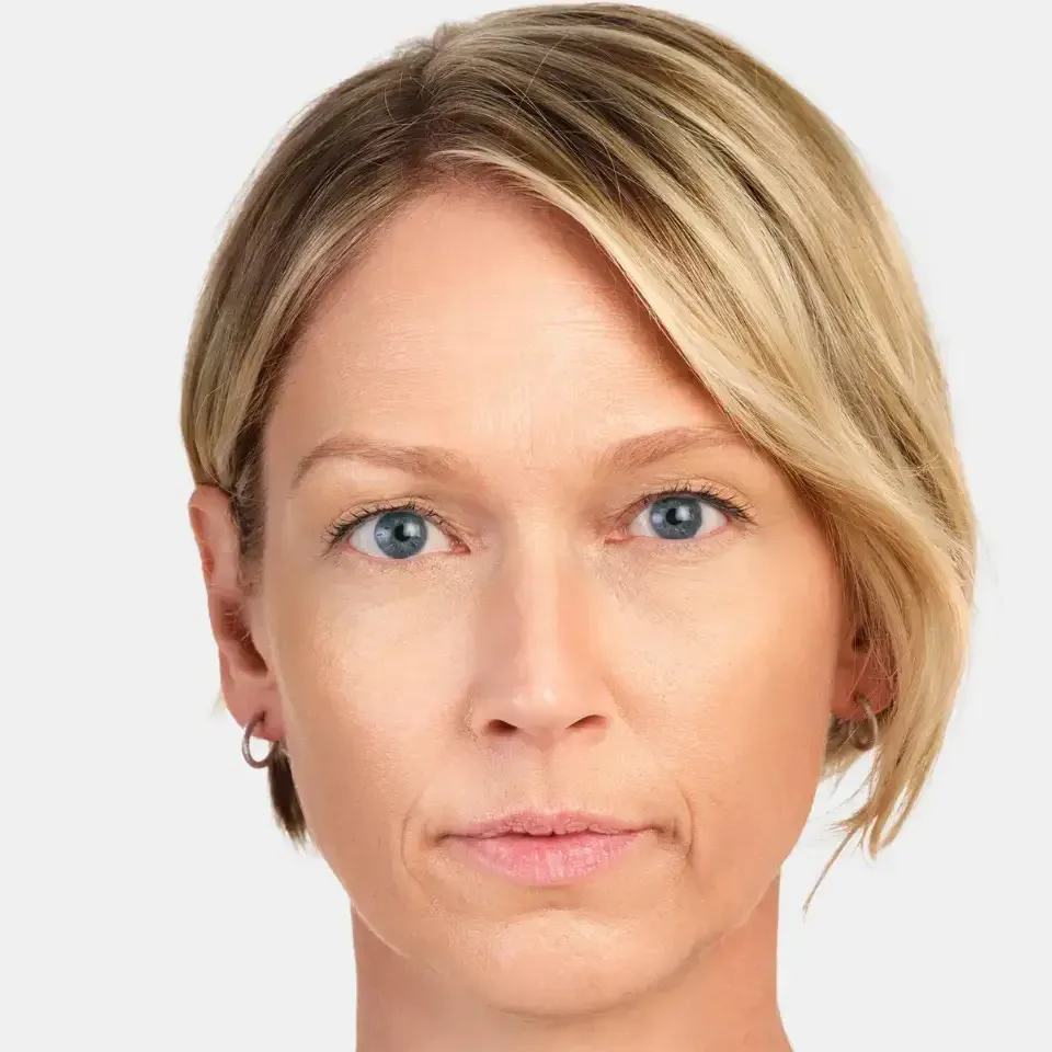 Radiesse, lower face and marionette area, after