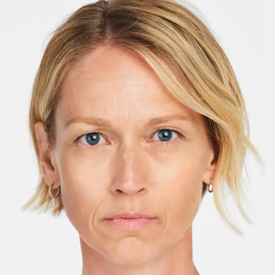 Radiesse, lower face and marionette area, before