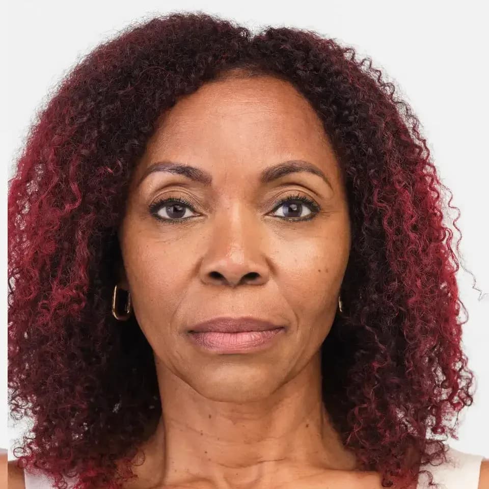 Radiesse, midface and lower face, after