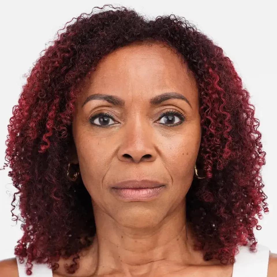 Radiesse, midface and lower face, before