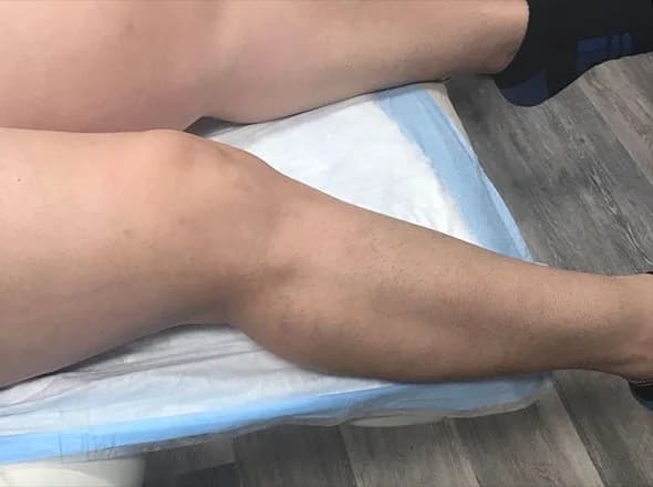 Sclerotherapy, spider veins on the leg, after