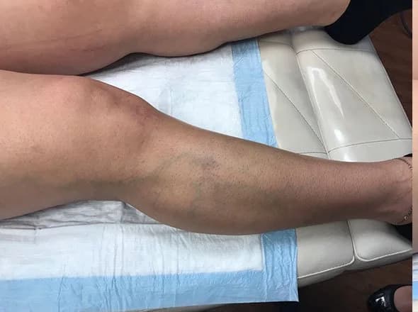 Sclerotherapy, spider veins on the leg, before