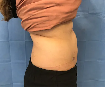 SculpSure, abdomen and flanks, side view, after
