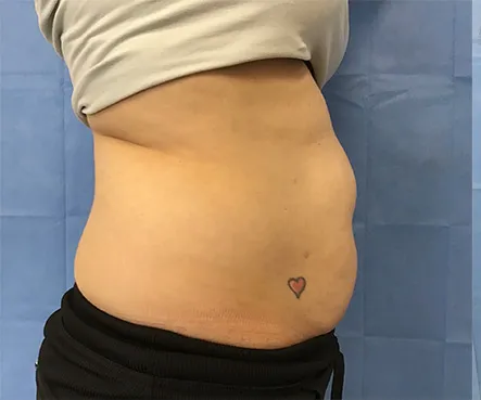 SculpSure, abdomen and flanks, side view, before