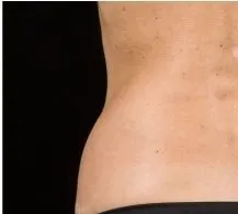 SculpSure, abdomen and flanks, side view, after