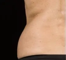 SculpSure, abdomen and flanks, side view, before