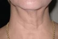 SkinTyte, neck, after