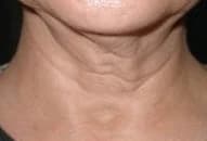 SkinTyte, neck, before