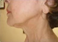 SkinTyte, jawline and neck, after