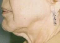 SkinTyte, jawline and neck, before