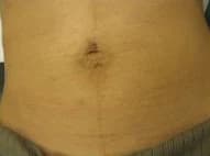 SkinTyte, abdomen, after
