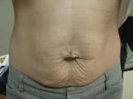 SkinTyte, abdomen, before
