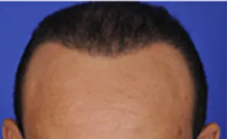 SmartGraft, frontal hairline, after