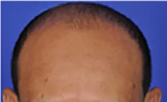 SmartGraft, frontal hairline, before