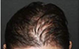 SmartGraft, part line, before