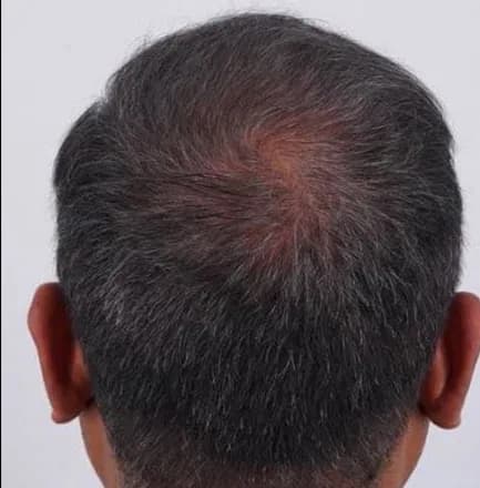 SmartGraft, crown density, after