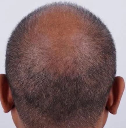 SmartGraft, crown density, before