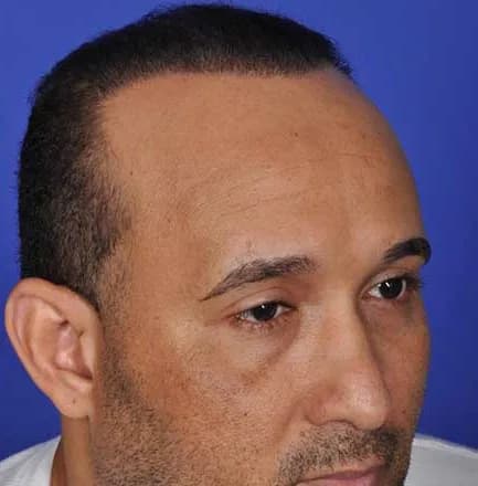 SmartGraft, hairline and temples, after