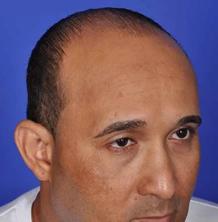 SmartGraft, hairline and temples, before