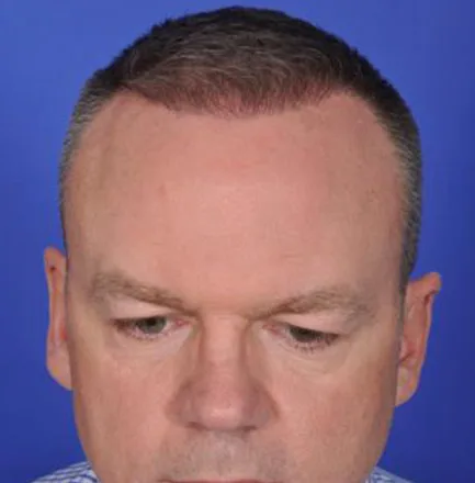 SmartGraft, frontal hairline, after