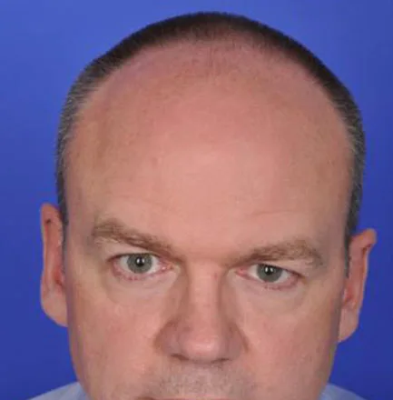 SmartGraft, frontal hairline, before