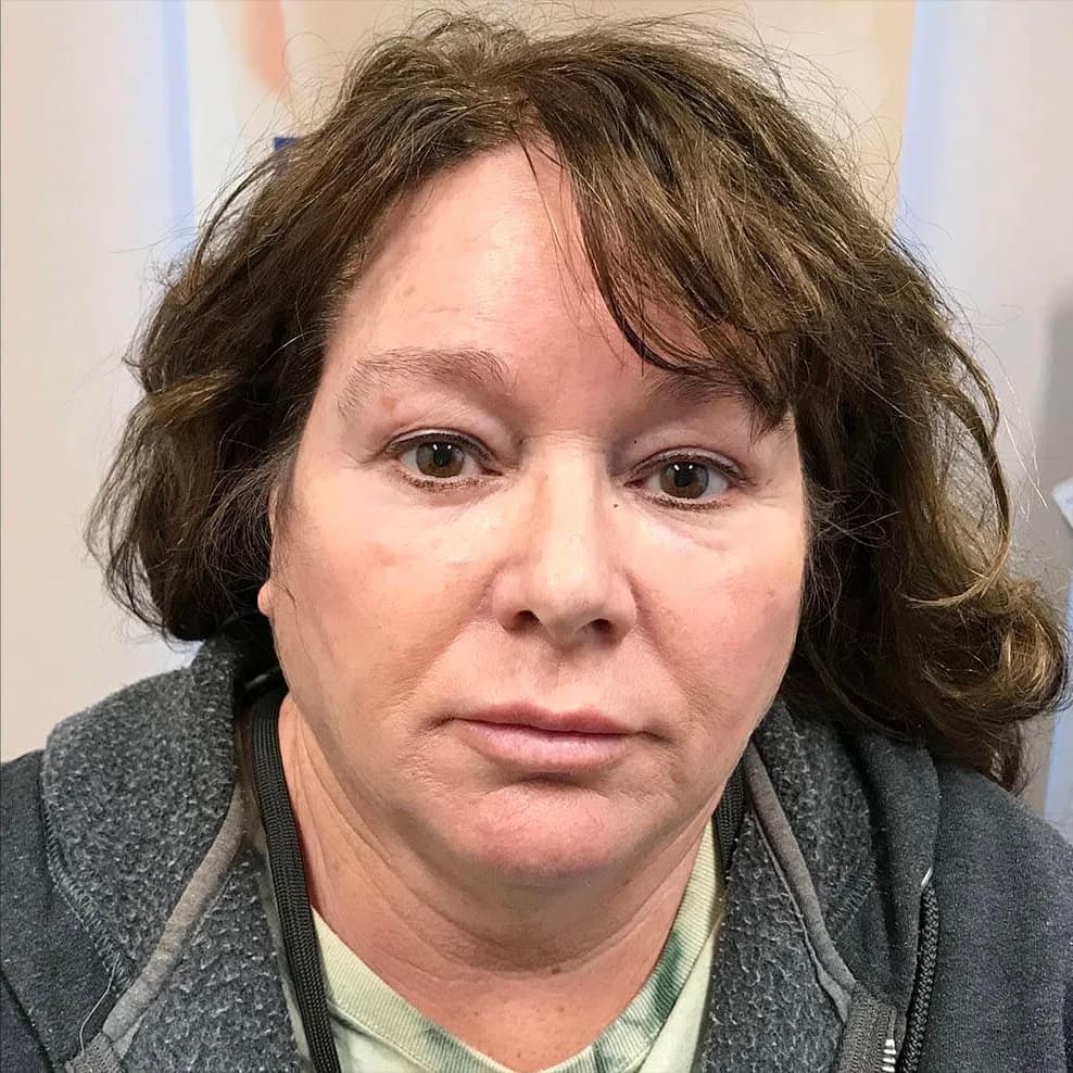 Thermage, full face, after