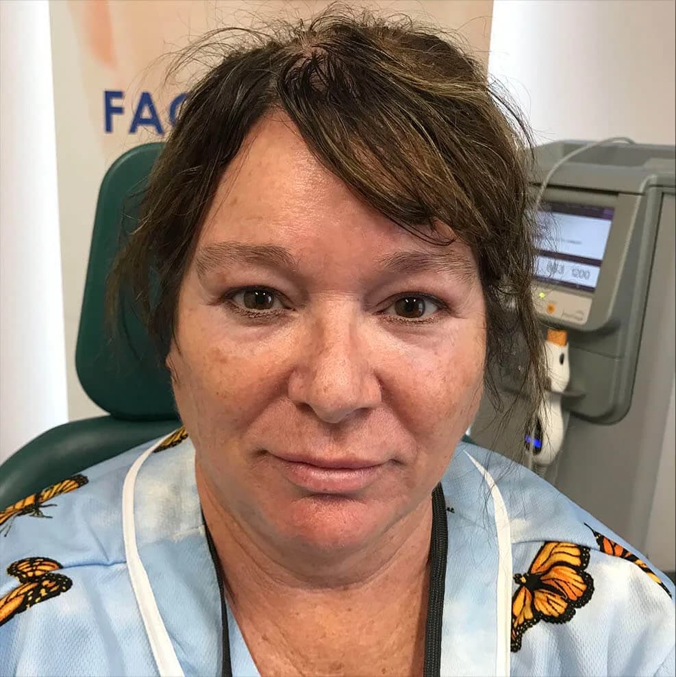 Thermage, full face, before