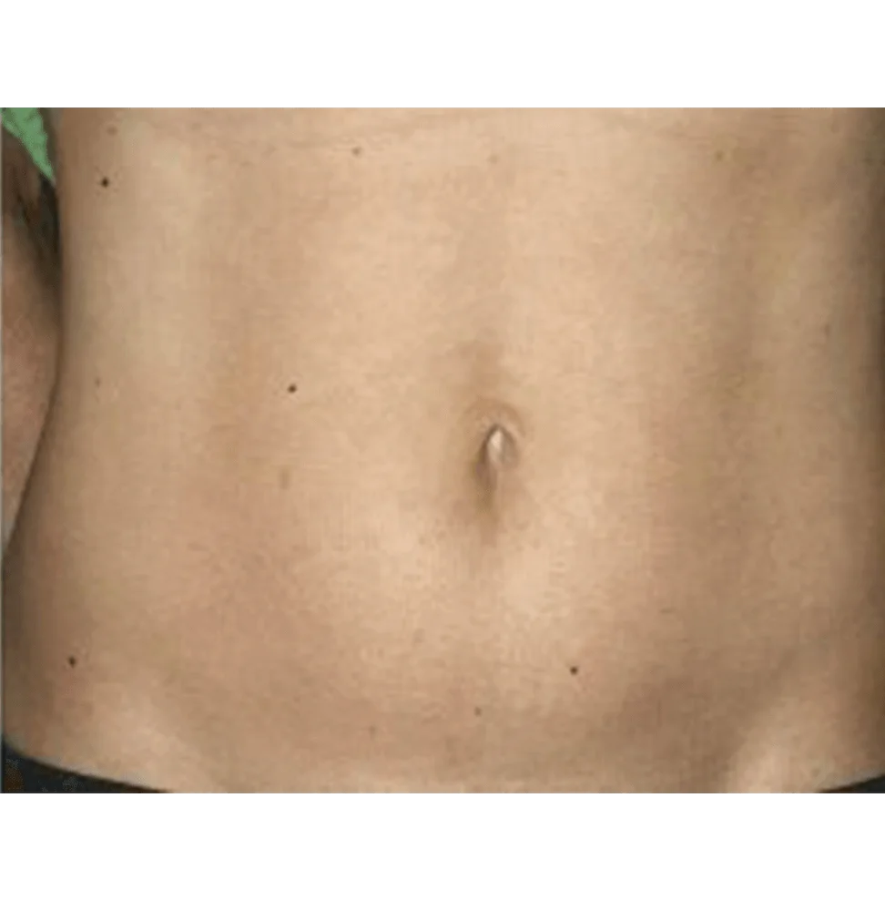 Thermage, abdomen skin tightening, after