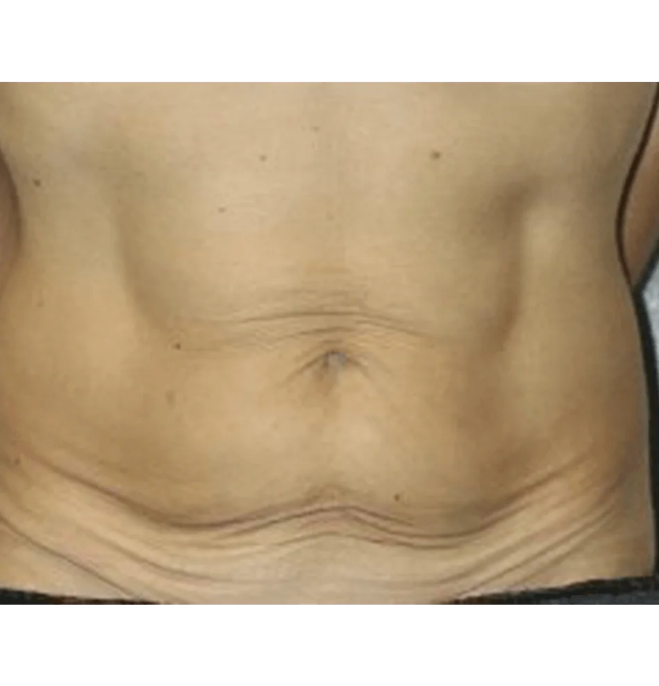 Thermage, abdomen skin tightening, before