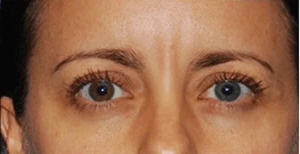 ThermiRase, before and after, after