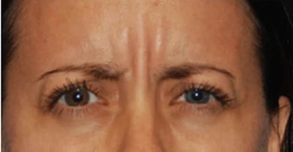 ThermiRase, before and after, before