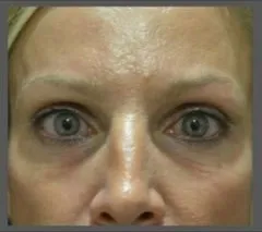 ThermiSmooth, under-eye area, after