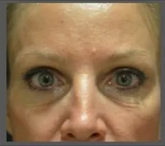 ThermiSmooth, under-eye area, before