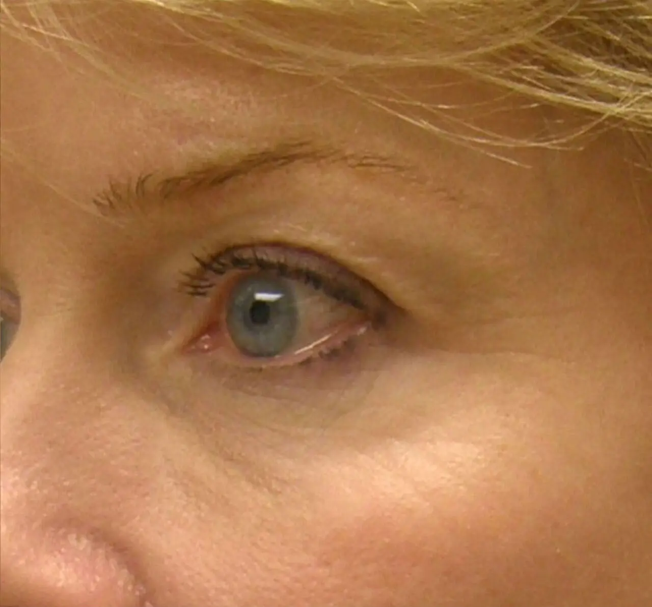 ThermiSmooth, around the eyes, after