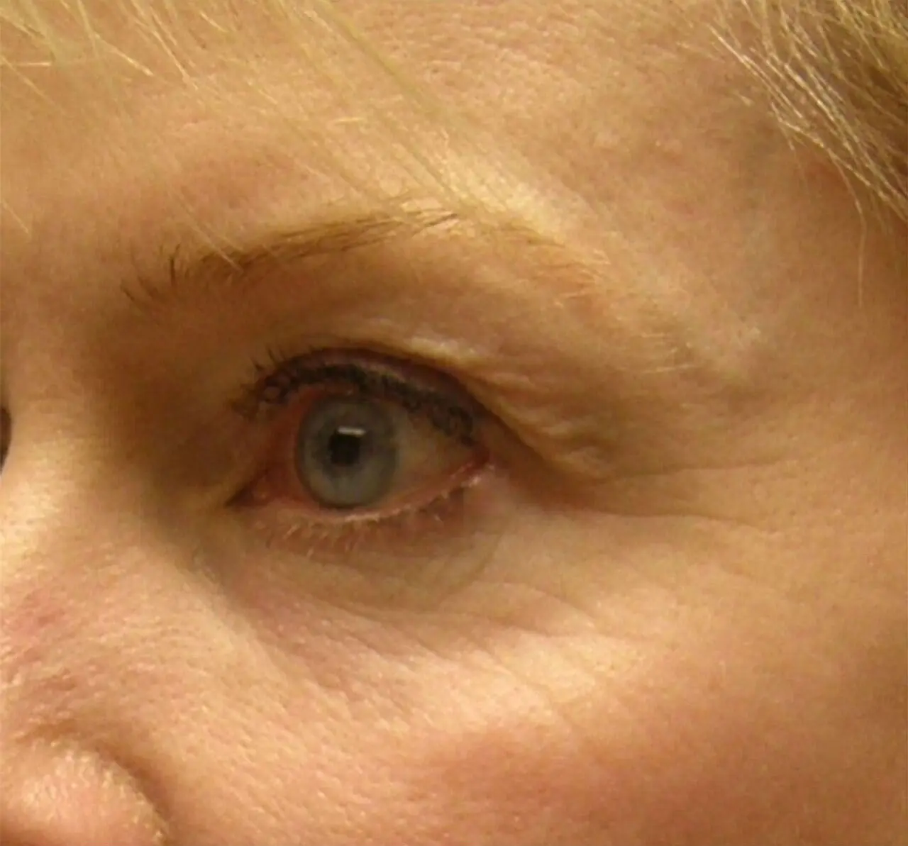 ThermiSmooth, around the eyes, before