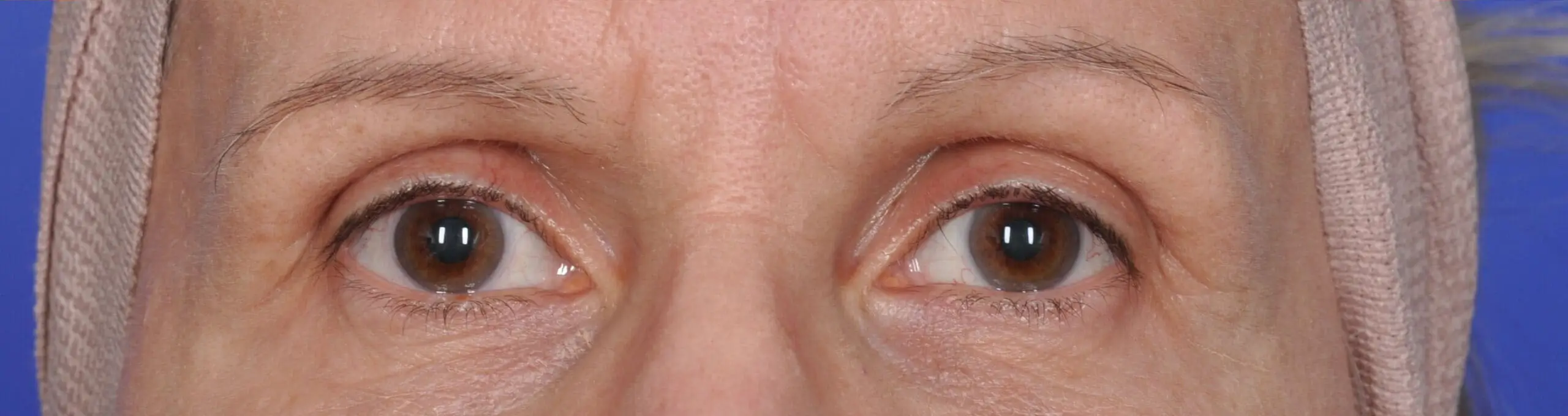 ThermiSmooth, upper eyelids, after