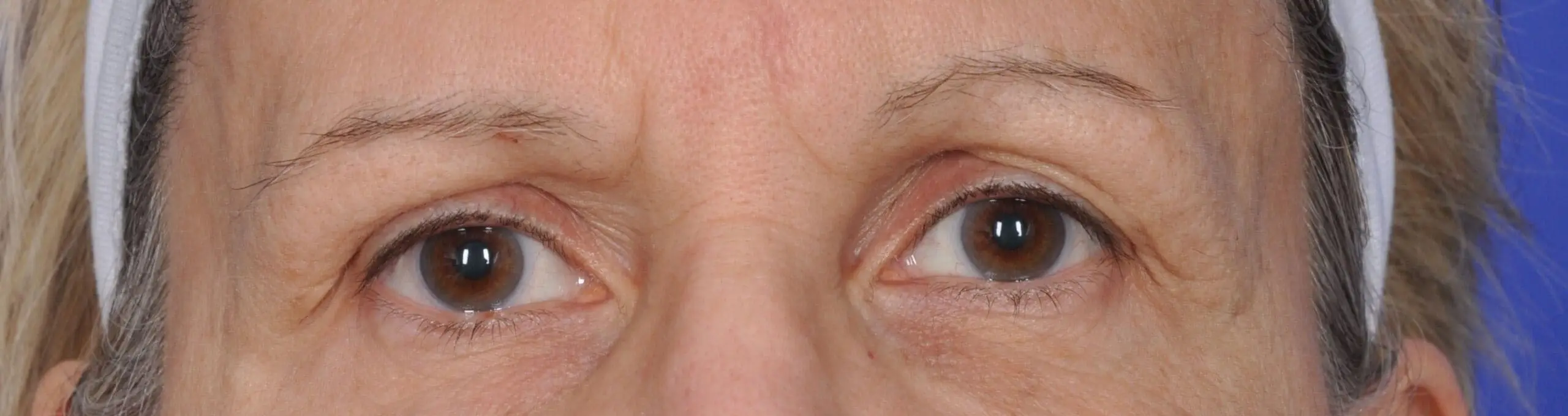 ThermiSmooth, upper eyelids, before