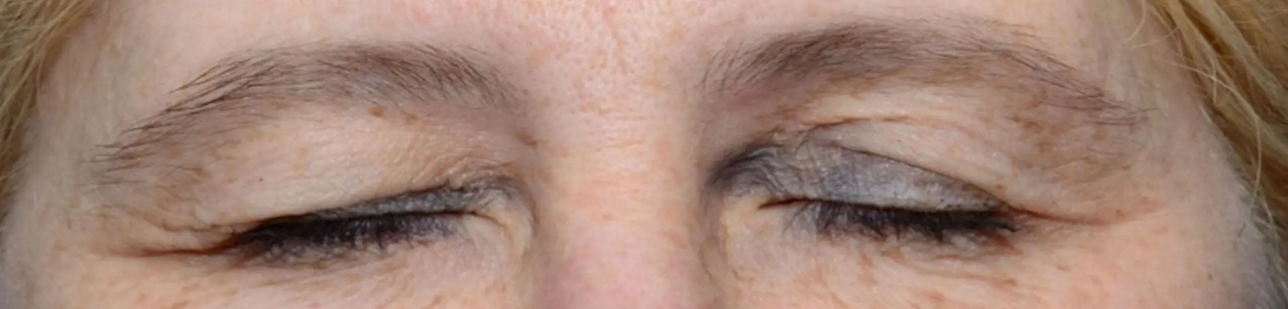 ThermiSmooth, crow's feet, before