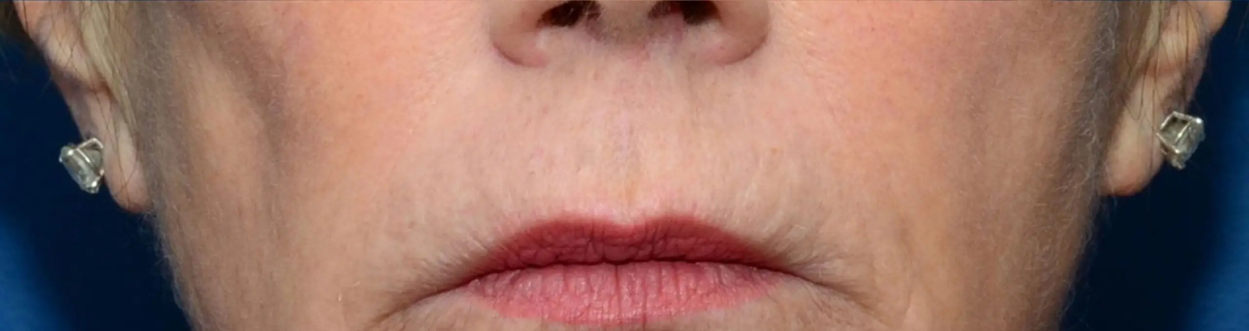 ThermiSmooth, around the mouth, after