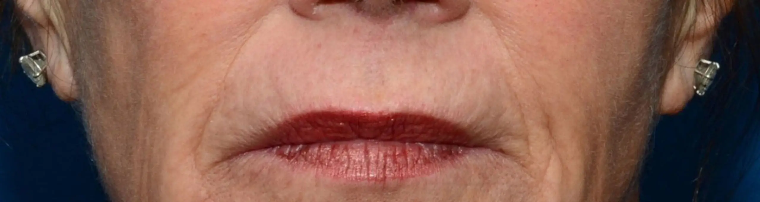 ThermiSmooth, around the mouth, before