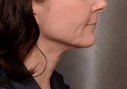 ThermiTight, neck and jawline, after