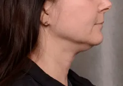 ThermiTight, neck and jawline, before