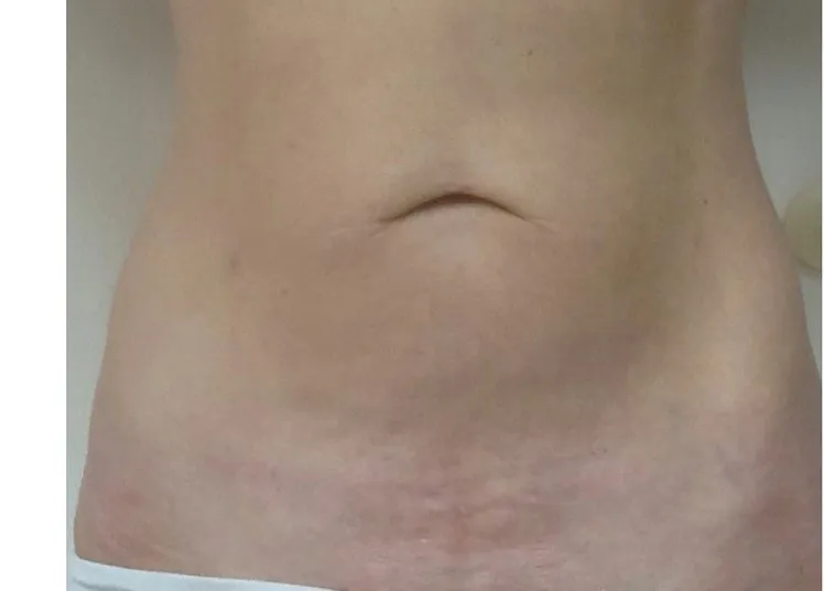 ThermiTight, abdomen, after
