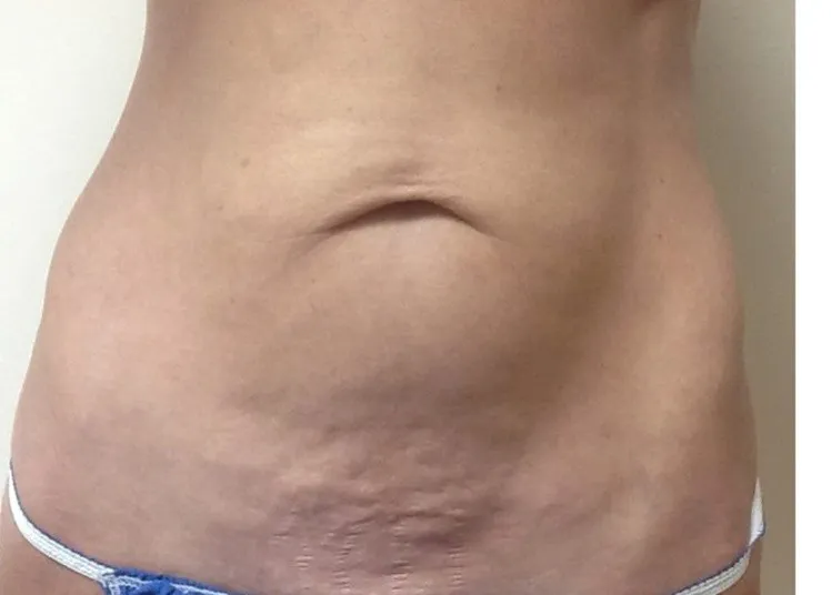ThermiTight, abdomen, before