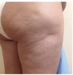 ThermiTight RF, cellulite on the thigh and buttock, before