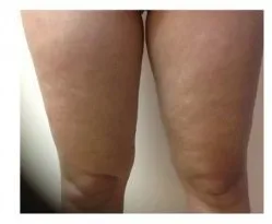 ThermiTight RF, fat and skin above the knees, after
