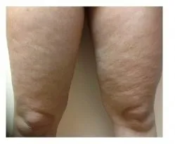 ThermiTight RF, fat and skin above the knees, before